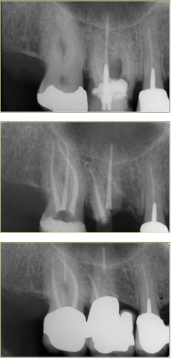 devitalizzare un dente devitalizzazione pisa