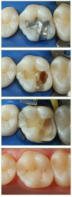 Otturazione denti per curare la carie a Pisa